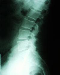 Normal Lumbar Spine X-ray
