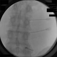Anterior-posterior fluoroscopic view of a RF neurotomy procedure