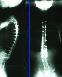 Post-operative scoliosis X-ray showing implants
