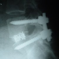 One level TLIF X-ray (Lateral view)