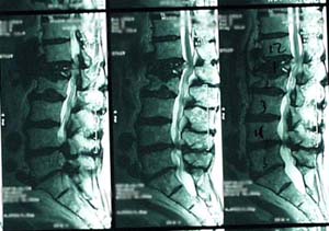 MRI of compression fracture