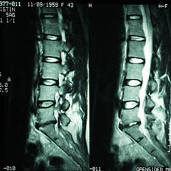 Lumbar spine MRI showing degenerated disc