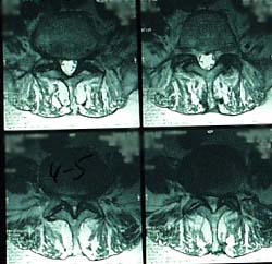 Axial MRI of the Lumbar spine