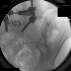 Sacroiliac Injection