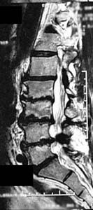 Sagittal MRI Lumbar Spine