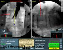 Computer image of spine surgery