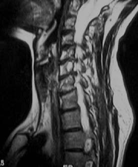 MRI Cervical Stenosis