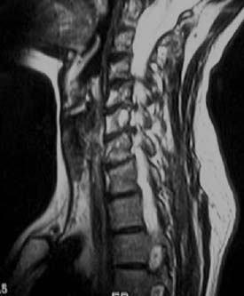 MRI-kuvantaminen kaularangan ahtauma