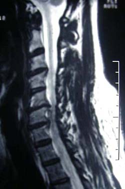 Cervical disc MRI