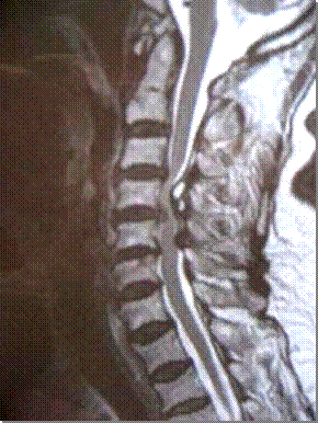 MRI cervical myelopathy