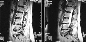 Sagittal lumbar MRI | disc degeneration
