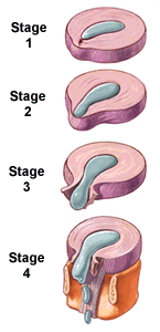 Stages of disc herniation