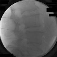 Lateral fluoroscopic view of a RF neurotomy procedure