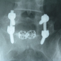 One level TLIF X-ray (AP view)