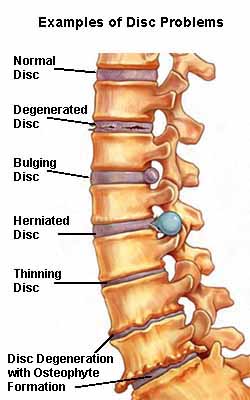 Examples of degenerative disc problems