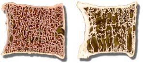 Normal bone vs. Osteoporotic bone