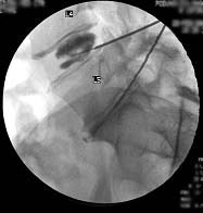 Lumbar Discography