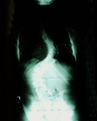X-ray Showing Severe Scoliosis