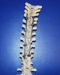 Bone model with scoliosis implants to reduce curvature 