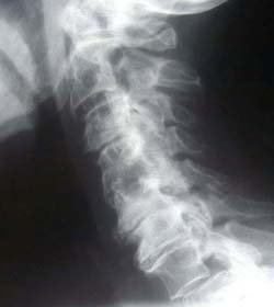 X-ray of Cervical Spine