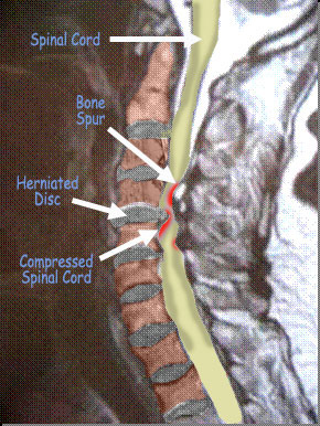 MRI cervical myelopathy 2