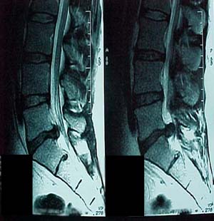 Sagittal lumbar MRI showing disc herniation