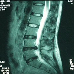 MRI showing herniated lumbar discs