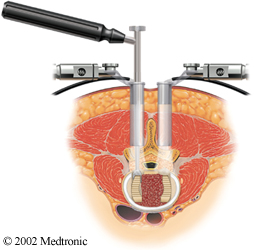 Spine surgery tool