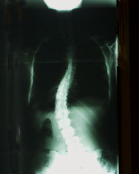 Adult Idiopathic Scoliosis X-ray