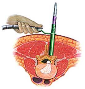 Endoscopic cannula for removal of a herniated disc