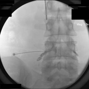 Selective Nerve Root Block