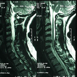 MRI of the Cervical Spine