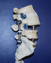 Sacrum bone model showing interbody cages, screws and rods