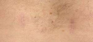 Postoperative minimally invasive surgery scars