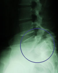 X-ray showing spondylolosthesis