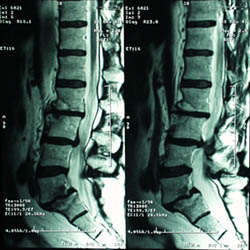 Lumbar MRI showing spondylolosthesis