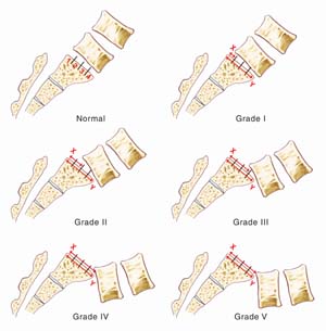 Spondylolisthesis grades