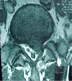 Axial MRI showing disc herniation