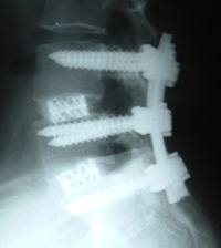 Two level TLIF X-ray (Lateral view)