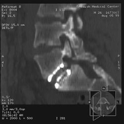CT Scan of Lumbar Spine