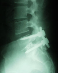 Post-operative x-ray showing spondylolisthesis implants